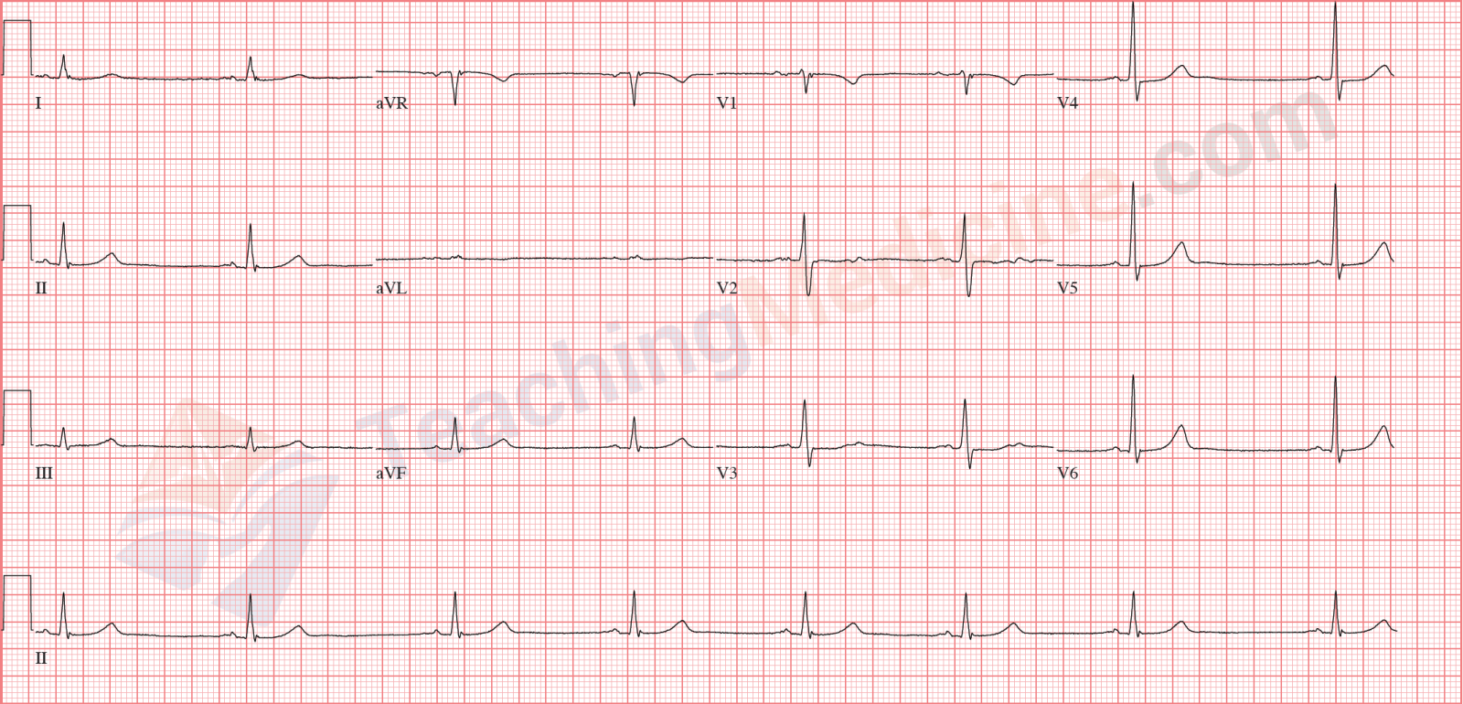 Sinus bradycardia